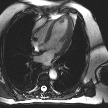 cardiac MRI